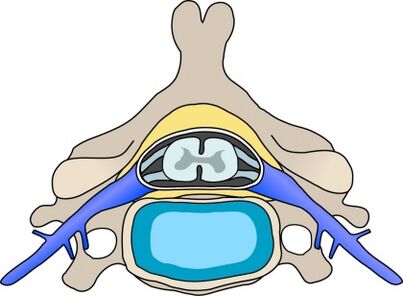 Protabius in the vertebra with cervical osteochondrosis