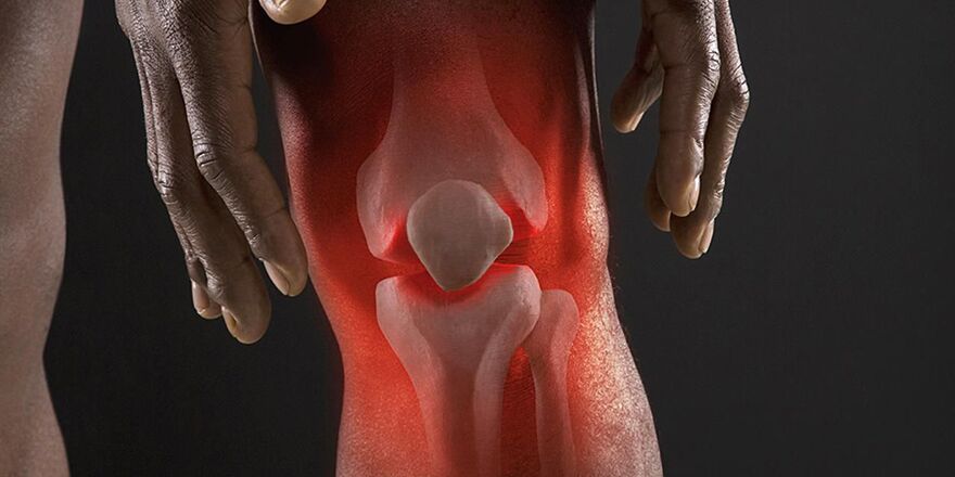 Burning sensation in the knee area is a symptom of gonarthrosis